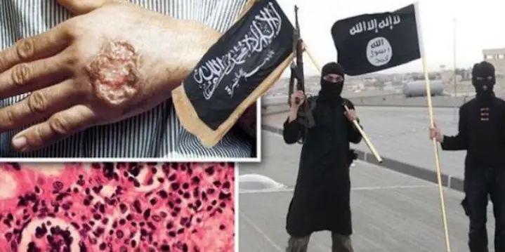 ISIS Hit with Fleshing-Eating Plague-Truth! But Misleading!