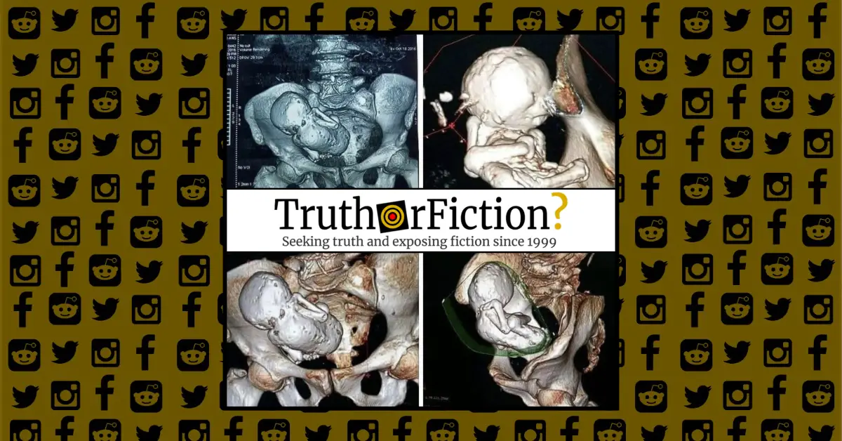 Did a Medical Scan of an 80-Year-Old Woman Reveal a Calcified Fetus?