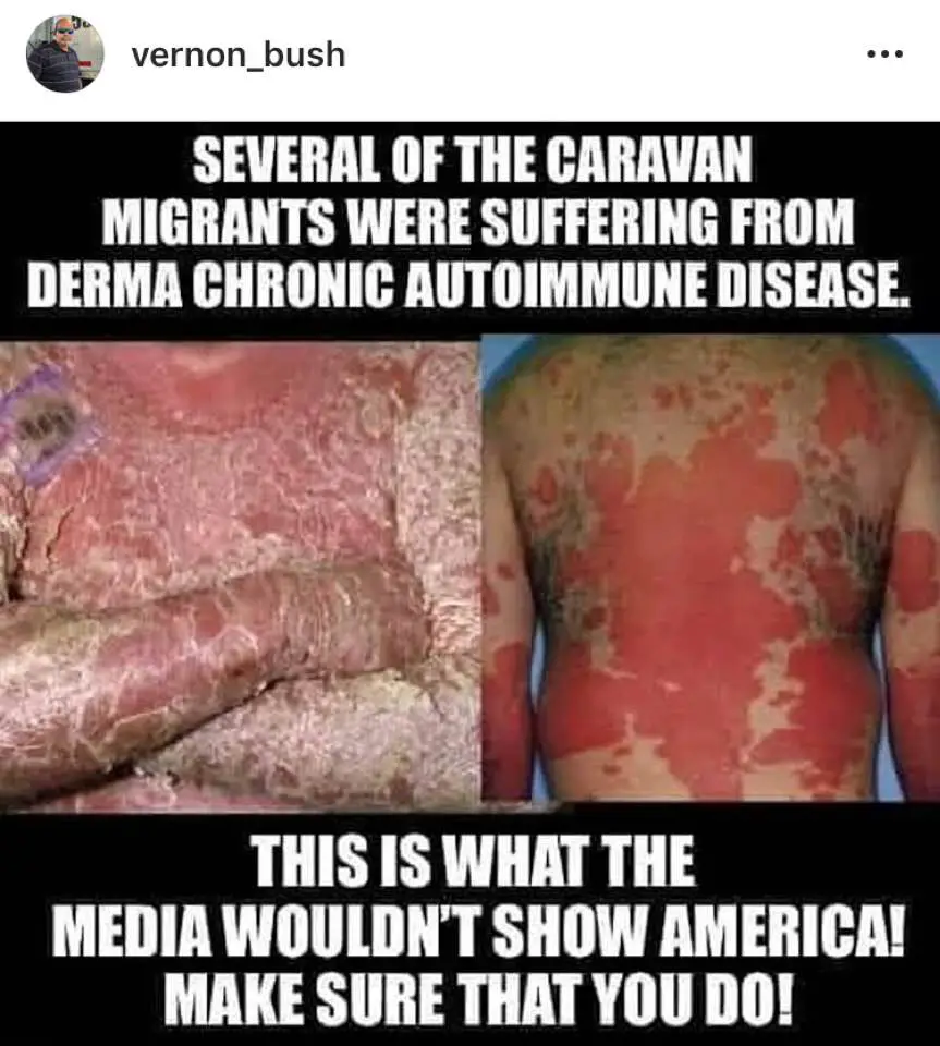 derma-chronic-autoimmune-disease-migrant