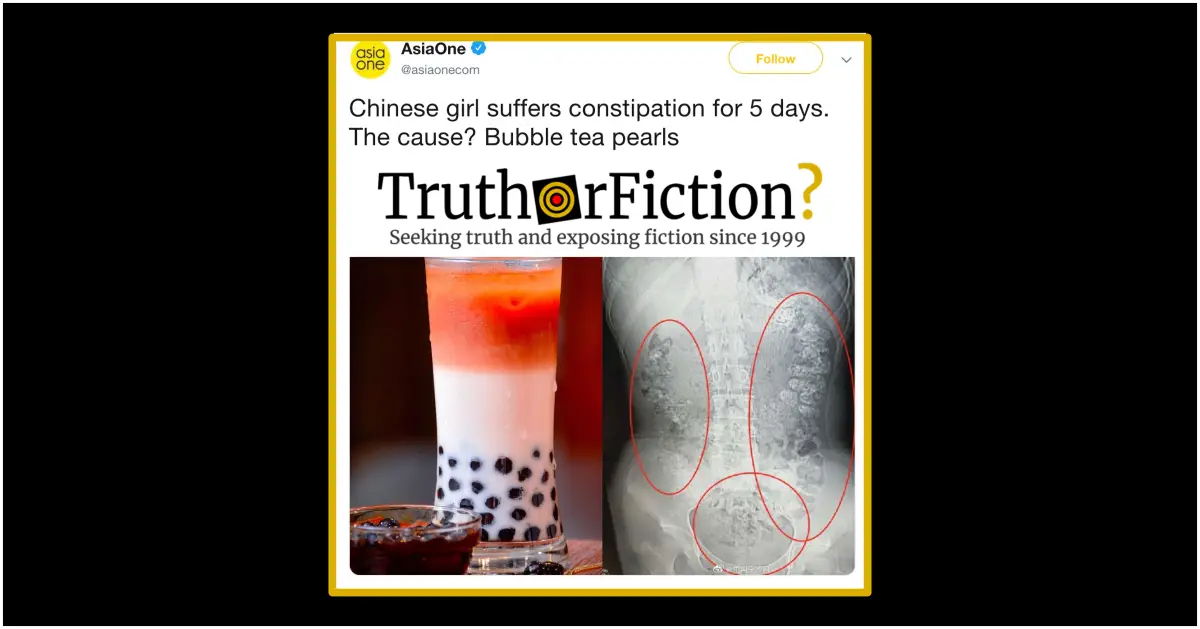 Does an X-Ray Show Hundreds of Undigested Boba Pearls in a Young Chinese Patient?